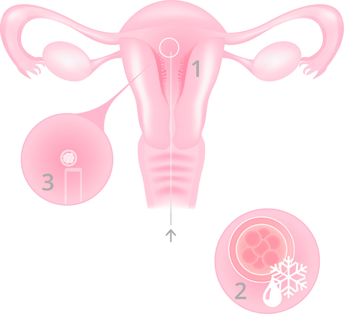 Embryo donation - Infographic