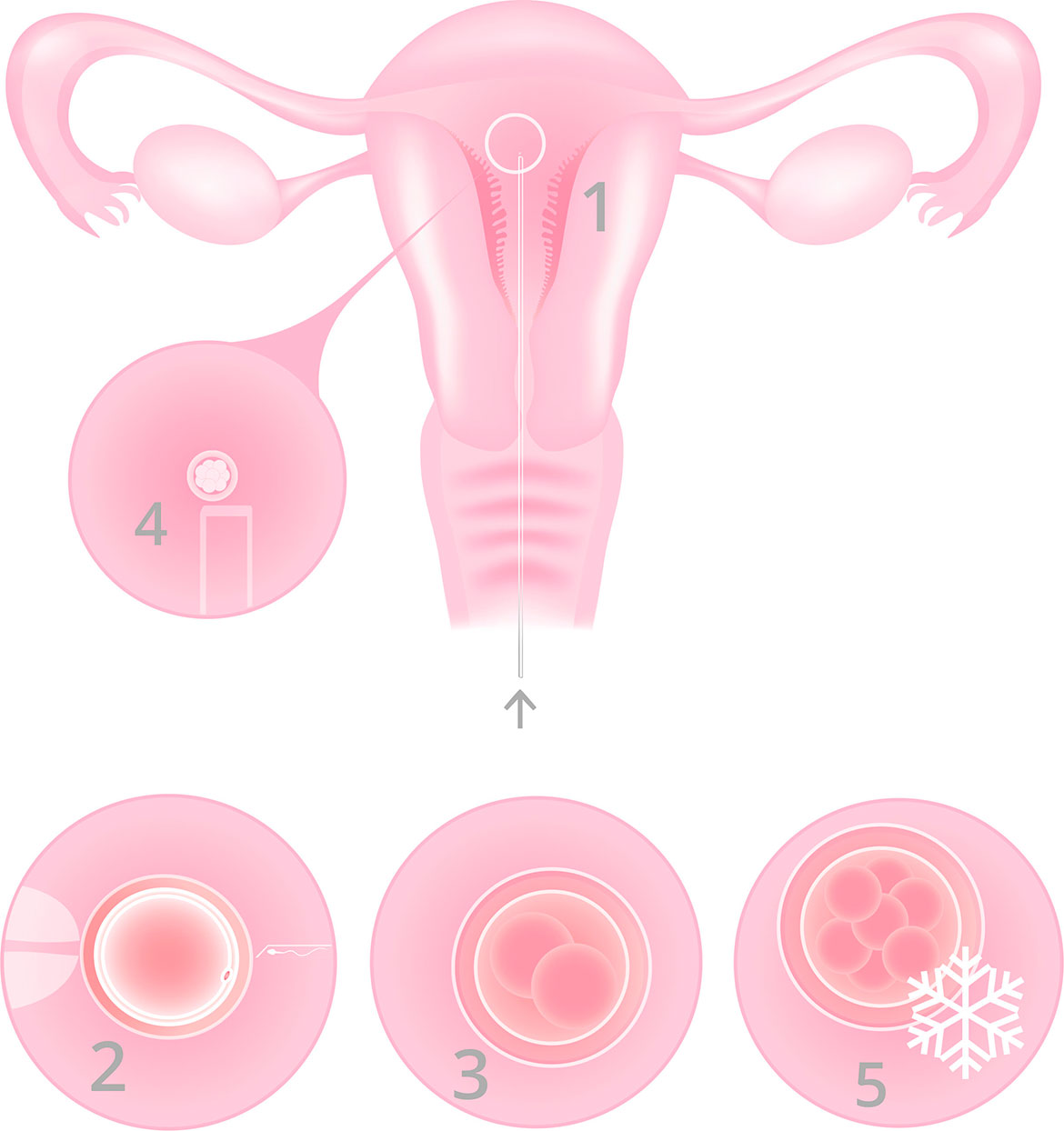 Egg donation - Infographic