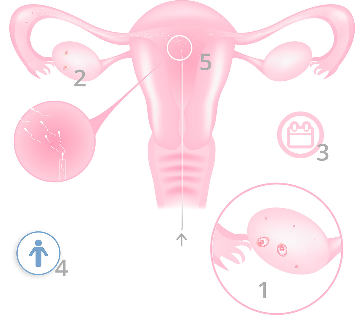 Artificial Insemination by husband (AIH) - Infographic