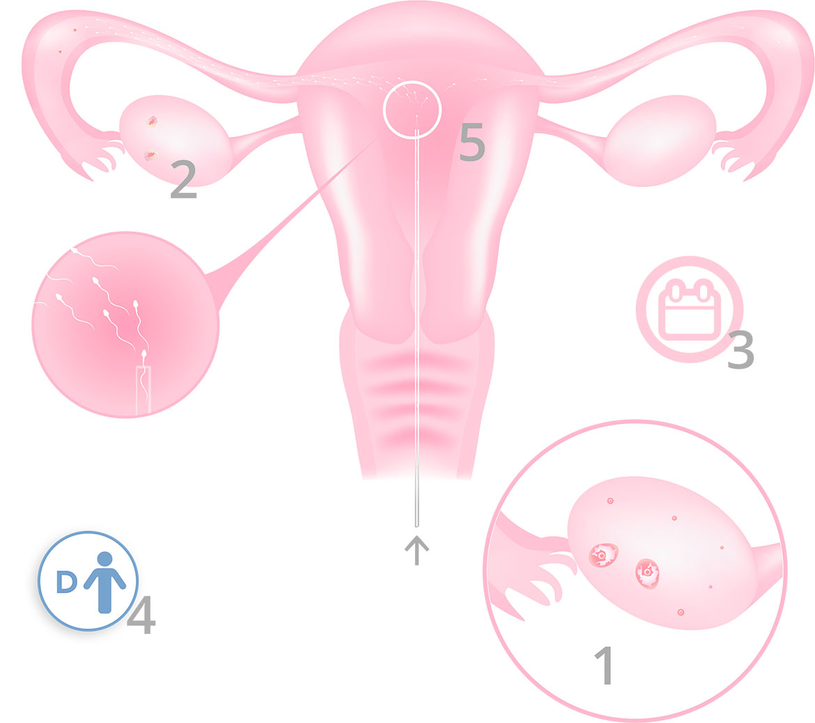 Artificial insemination by donor - Infografica