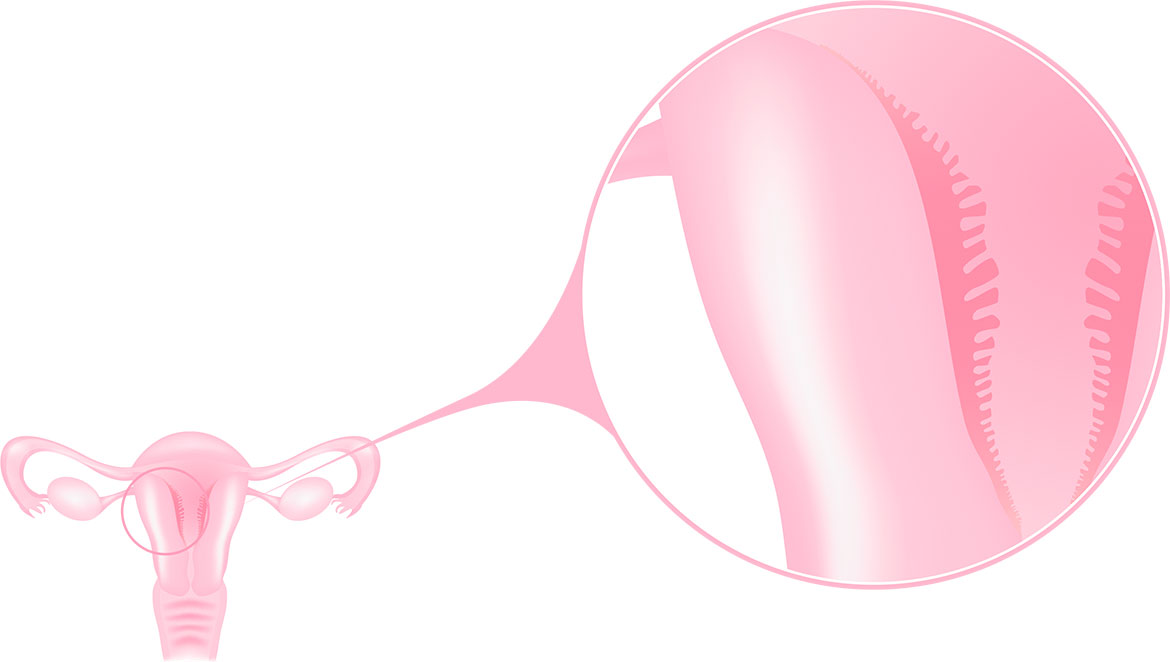 Infographic Endometrial receptivity test