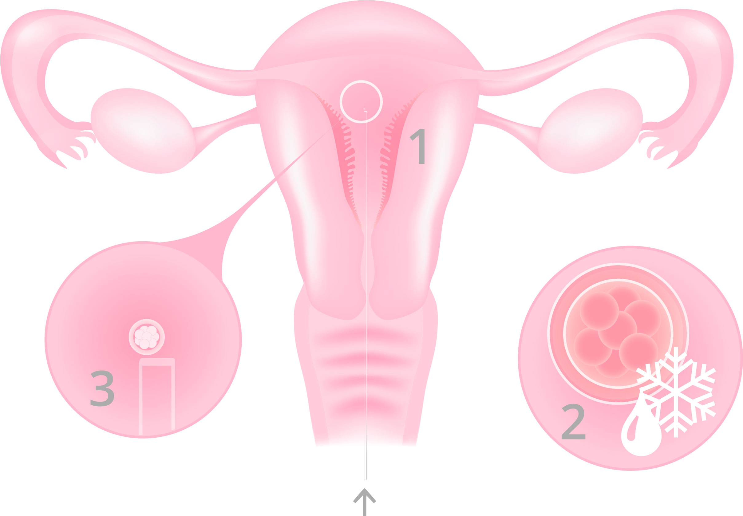 Embryo transfer - Infographic